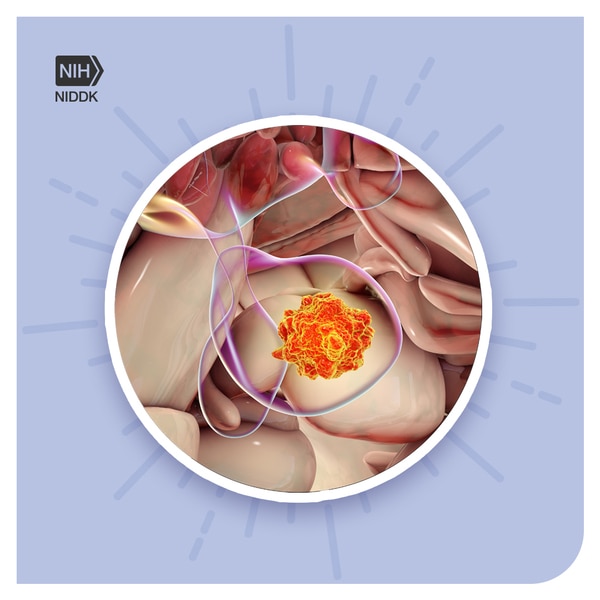 A prolactinoma, which is a benign that develops on the pituitary gland.